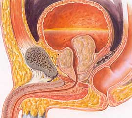 前立腺肥大症とは？