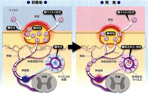 原因と感染経路